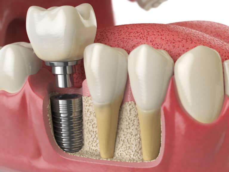Anatomy,Of,Healthy,Teeth,And,Tooth,Dental,Implant,In,Human